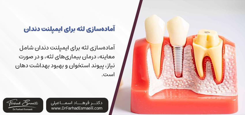 آمادهسازی لثه برای ایمپلنت دندان | مطب دکتر فرهاد اسماعیلی
