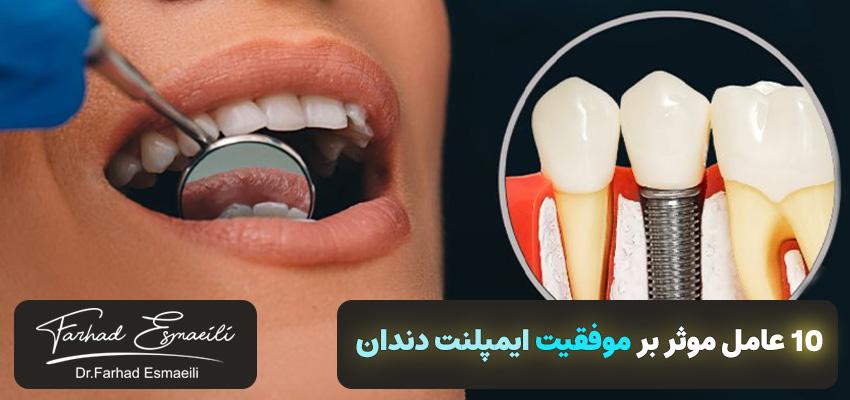 10 عامل موثر بر موفقیت ایمپلنت دندان | دکتر فرهاد اسماعیلی