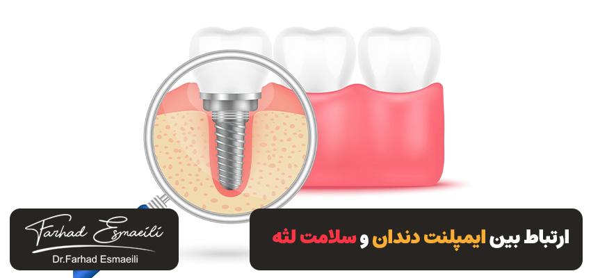 ارتباط بین ایمپلنت دندان و سلامت لثه | نکات مهم | دکتر فرهاد اسماعیلی در اصفهان