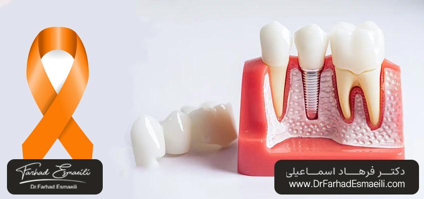 اثرات بیماری ام اس بر روند ایمپلنت دندان | دکتر فرهاد اسماعیلی