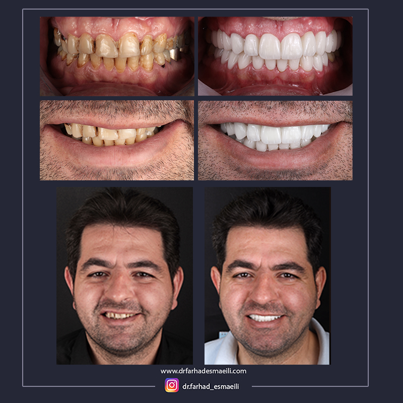 لمینیت سرامیکی دیجیتال دندان در اصفهان | دکتر فرهاد اسماعیلی