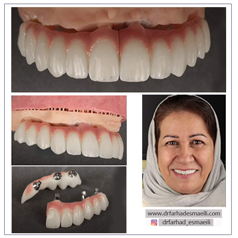 لمینیت سرامیکی دیجیتال دندان در اصفهان | دکتر فرهاد اسماعیلی