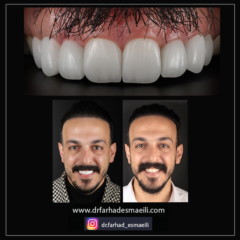 لمینیت سرامیکی دیجیتال دندان در اصفهان | دکتر فرهاد اسماعیلی