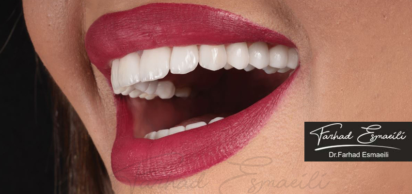 لمینت بهتر است یا کامپوزیت؟ مقایسه کامل و تخصصی