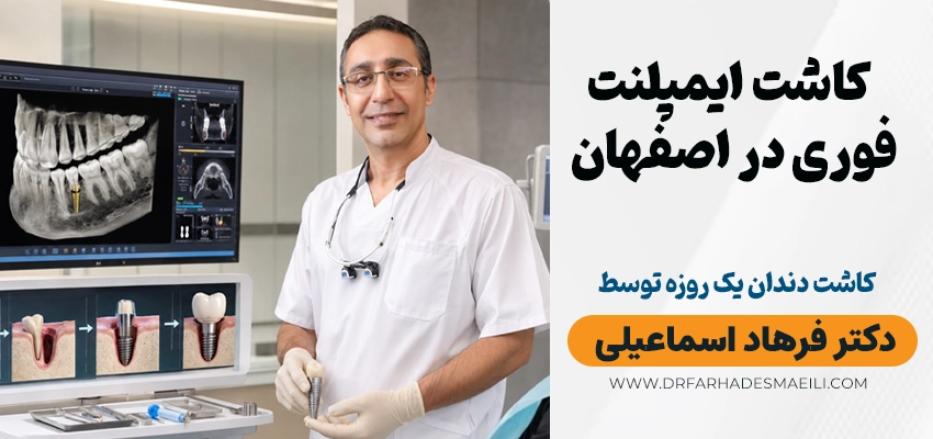 کاشت ایمپلنت فوری در اصفهان - دکتر فرهاد اسماعیلی