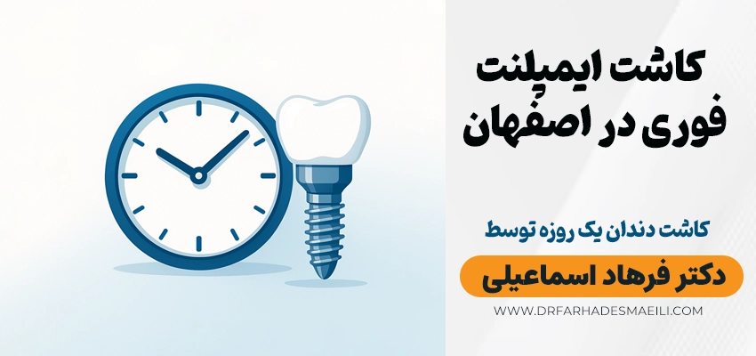 ایمپلنت فوری در اصفهان کاشت دندان یک روزه توسط دکتر فرهاد اسماعیلی