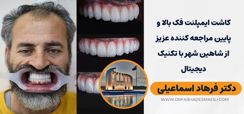 کاشت ایمپلنت فک بالا و پایین مراجعه کننده عزیز از شاهین شهر با تکنیک دیجیتال