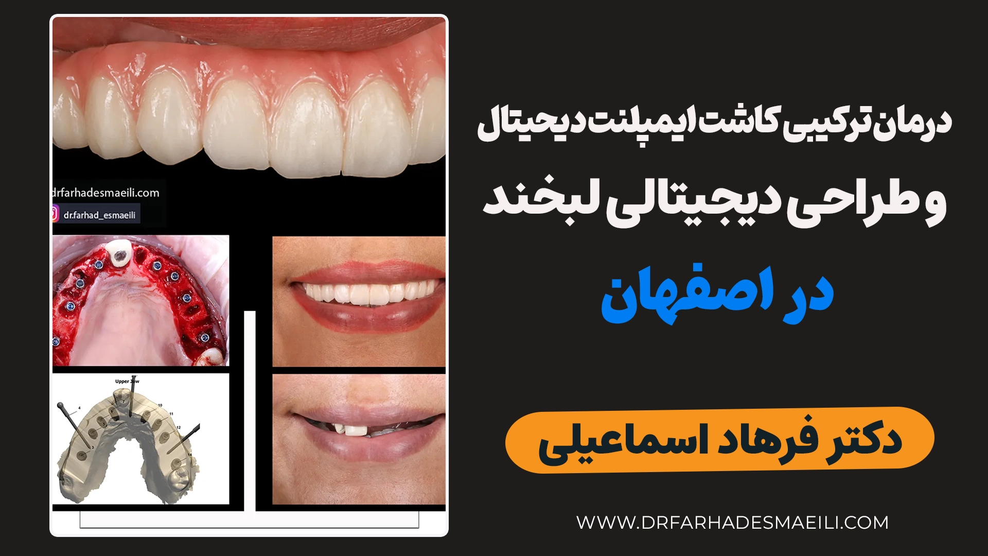 درمان ترکیبی کاشت ایمپلنت دیجیتال و زیبایی مراجعه کننده عزیز از توحید اصفهان