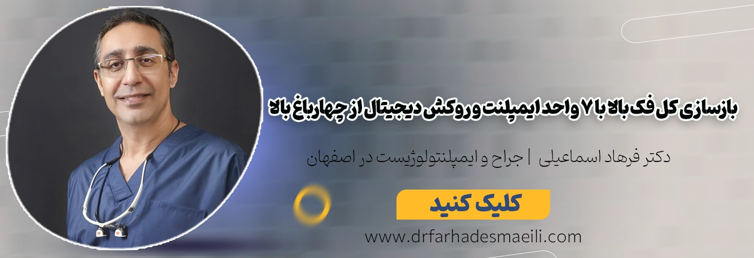 بازسازی کامل فک بالا با ۷ پایه ایمپلنت و روکش دیجیتال در اصفهان (گزارش درمان بیمار از چهارباغ بالا)