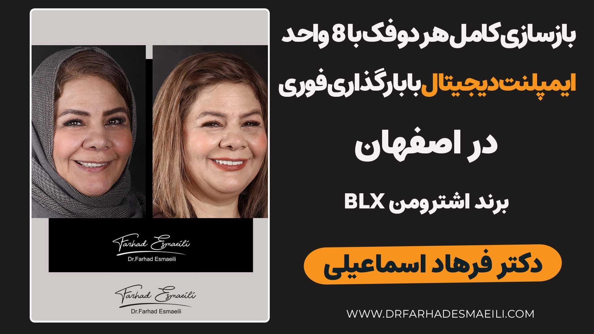 کاشت ۸ واحد ایمپلنت دیجیتال با بارگذاری فوری از رفسنجان | برند اشترومن BLX