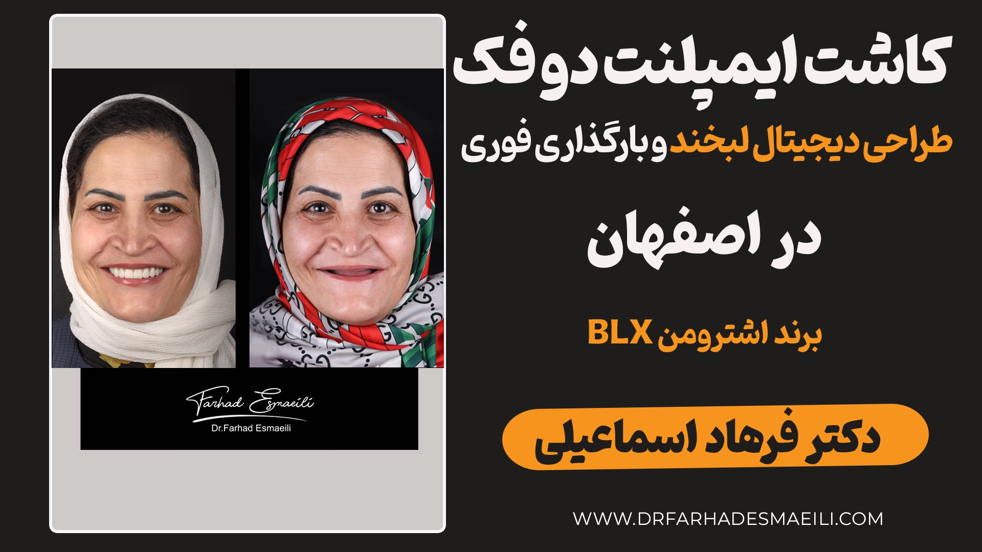 کاشت ایمپلنت کامل دو فک با اشترومن BLX: درمان یک‌روزه برای بیمار اردستان ایمپلنت دیجیتال دو فک در یک روز با اشترومن