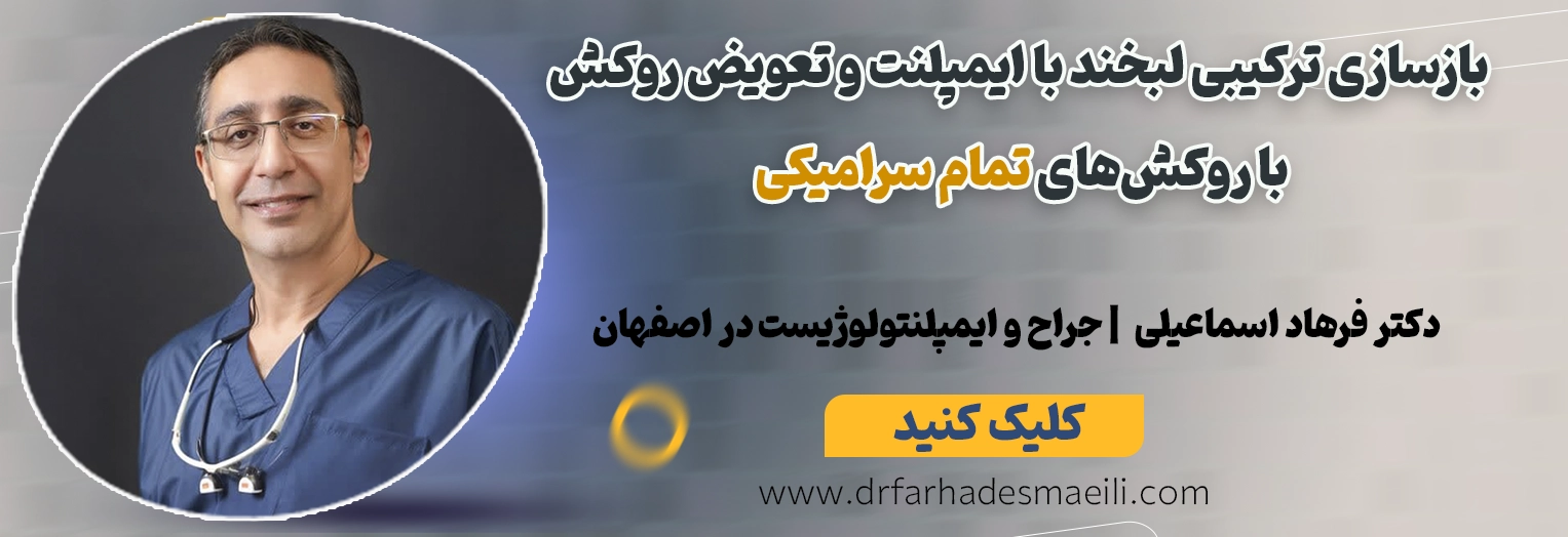 رزرو نوبت جهت بازسازی کامل لبخند با ایمپلنت دیجیتال، پیوند استخوان و تعویض روکشهای قدیمی ایمپلنت در اصفهان توسط دکتر فرهاد اسماعیلی