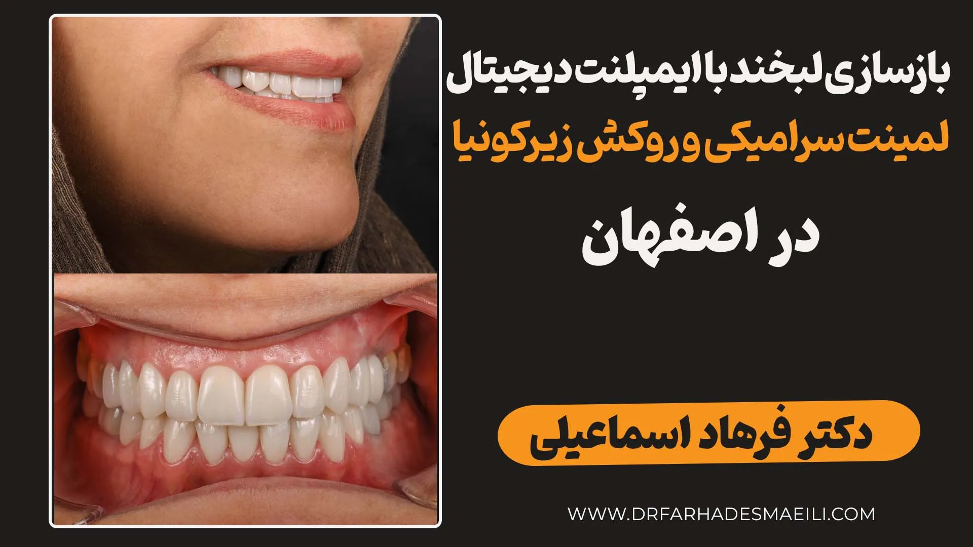 بازسازی جامع لبخند با ترکیب ایمپلنت BEGO، جراحی لثه و لمینت سرامیکی