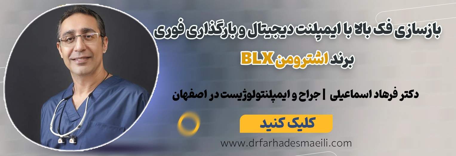 رزرو نوبت با دکتر فرهاد اسماعیلی جهت بازسازی کامل فک بالا با ایمپلنت دیجیتال و روکش سرامیکی در اصفهان