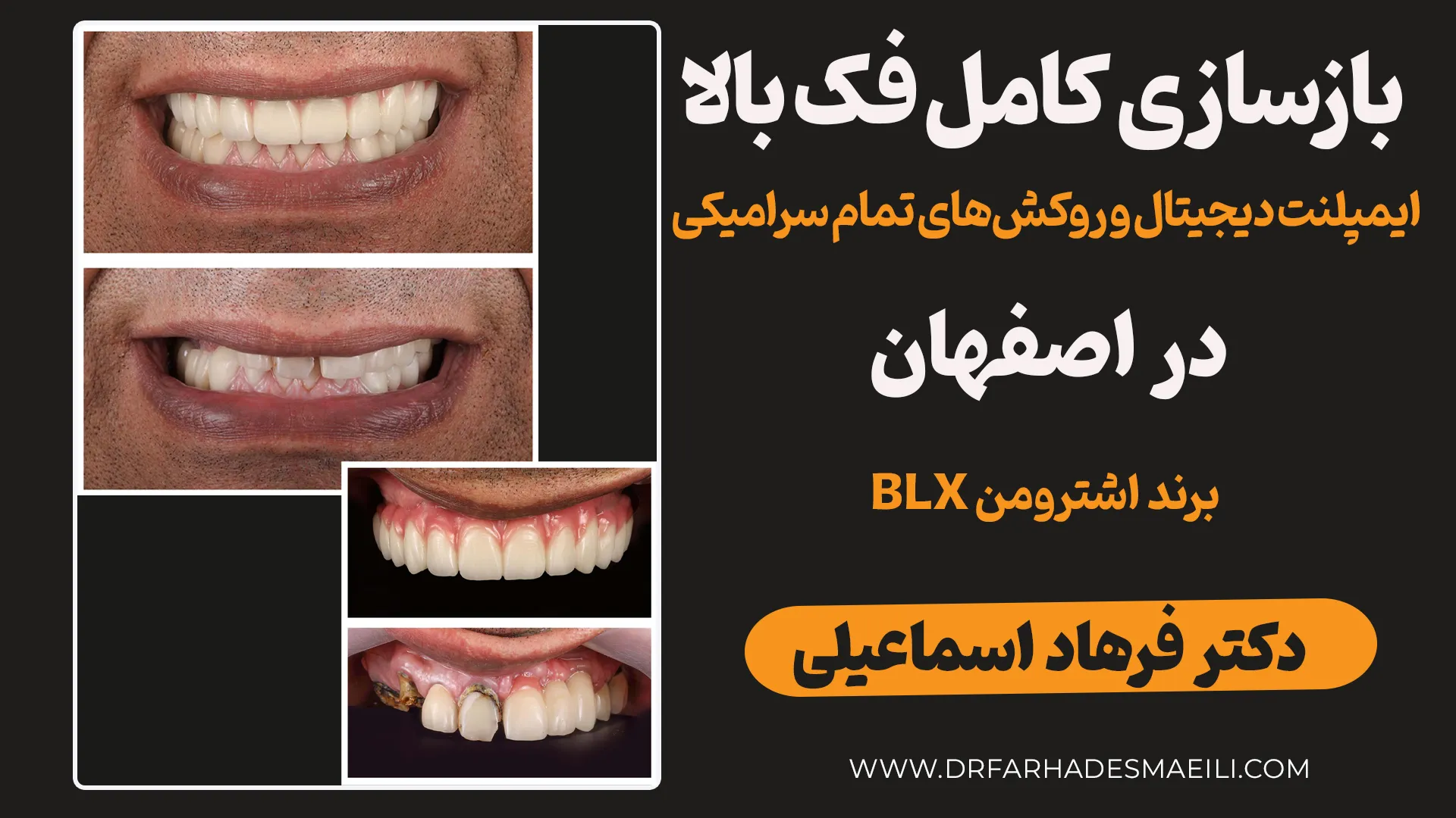 گزارش بالینی از بازسازی کامل لبخند با ایمپلنت دیجیتال، پیوند استخوان و تعویض روکش‌های قدیمی ایمپلنت