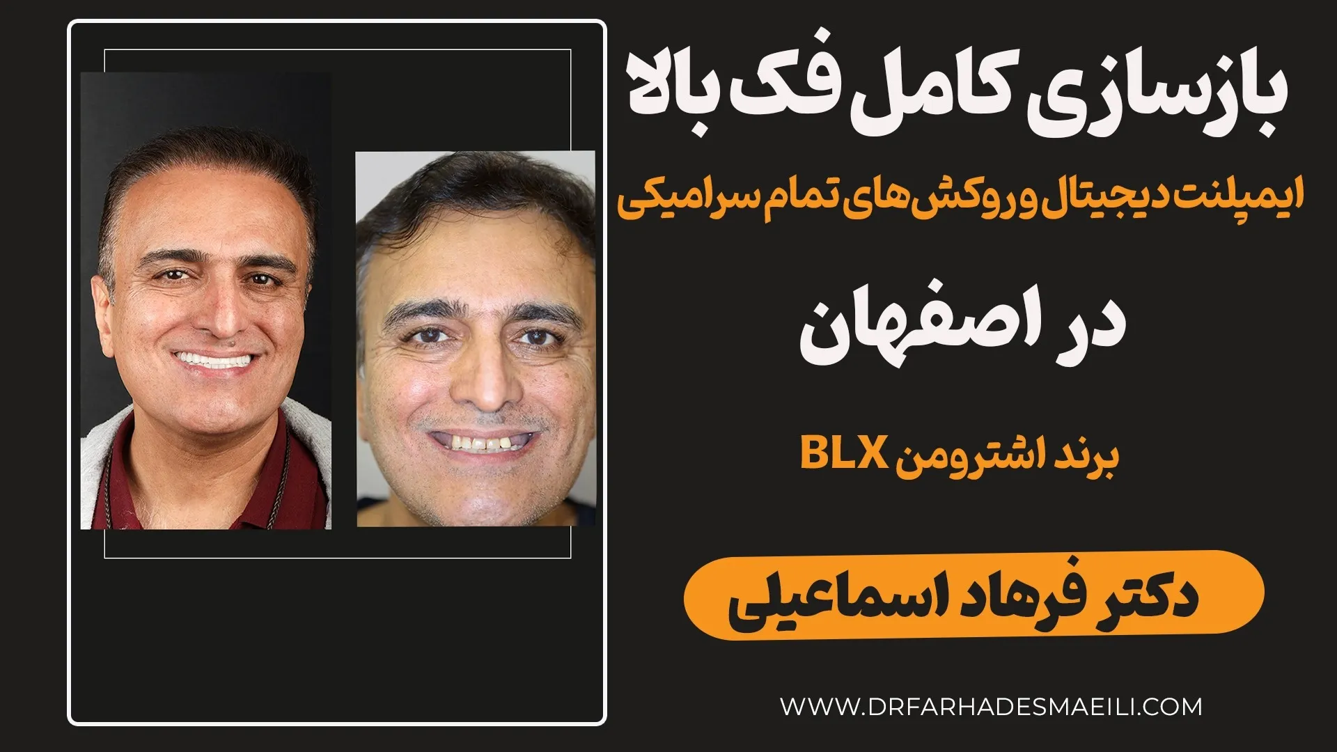 تجربه درمان: بازسازی کامل فک بالا با ۸ واحد ایمپلنت دیجیتال و روکش سرامیکی