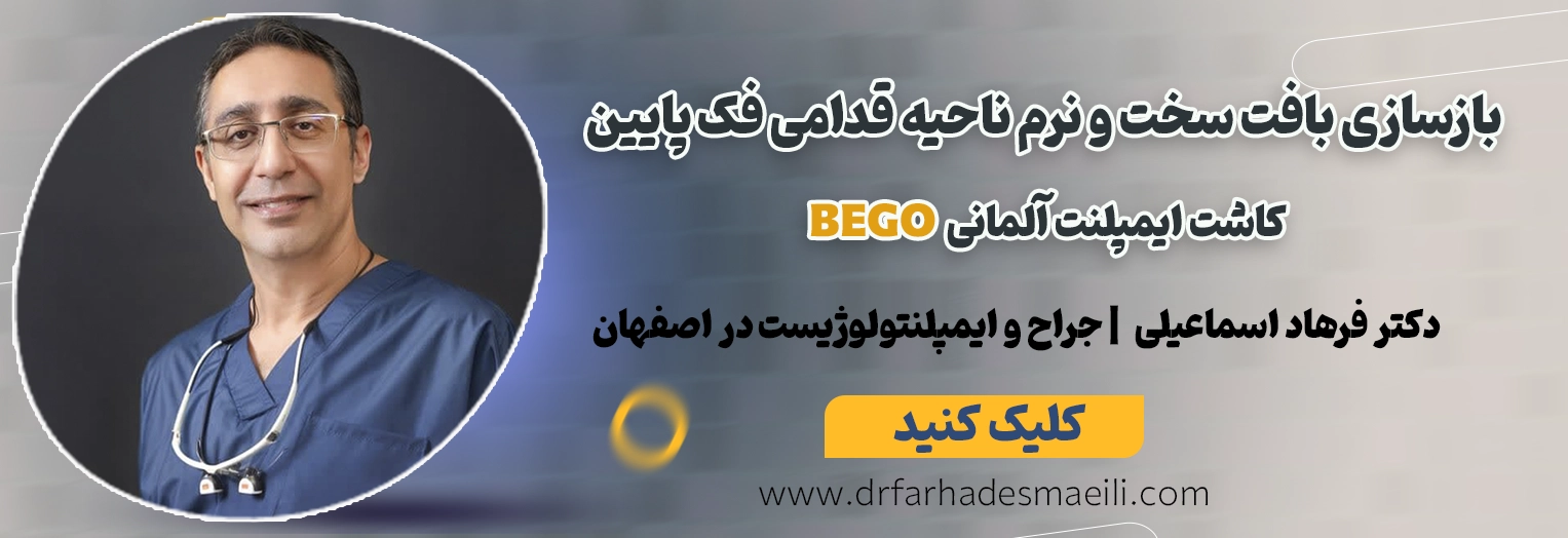 رزرو نوبت برای بازسازی کامل فک بالا با ایمپلنت دیجیتال در اصفهان توسط دکتر فرهاد اسماعیلی