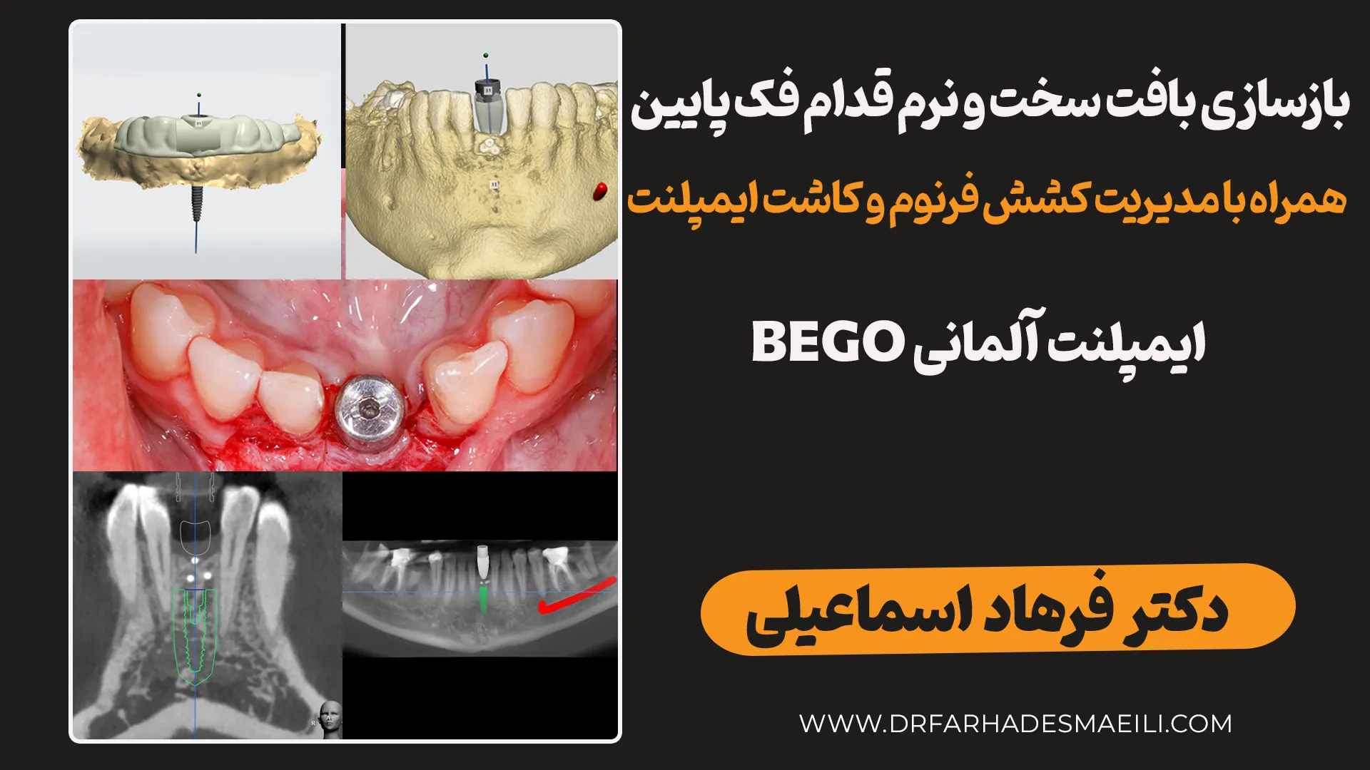 بازسازی بافت سخت و نرم قدام فک پایین همراه با مدیریت کشش فرنوم و کاشت ایمپلنت
