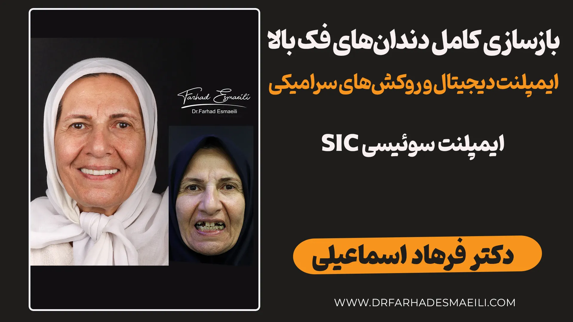 گزارش کیس درمانی: بازسازی کامل فک بالا با ایمپلنت دیجیتال؛ از طراحی تا لبخند نهایی