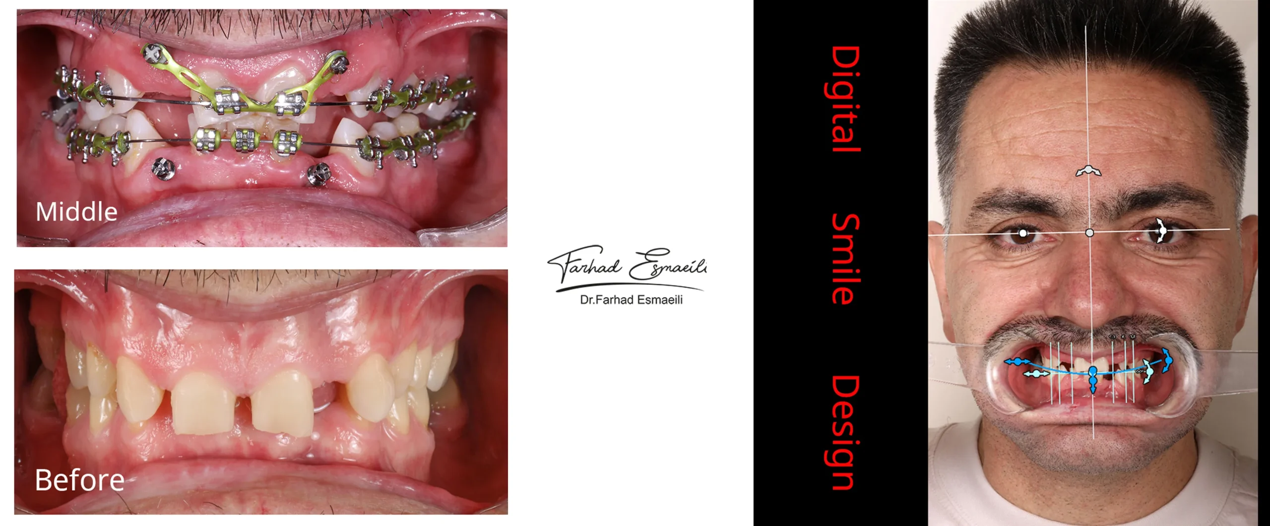 طراحی مجدد لبخند و کالیبراسیون (DSD)