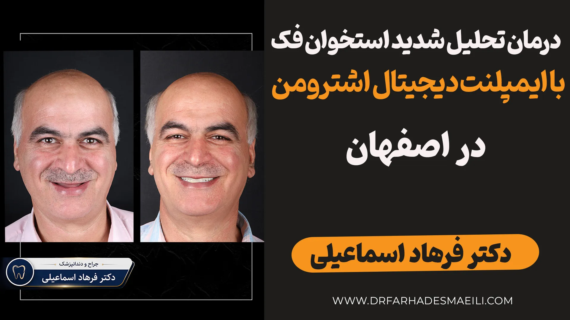 بازسازی پیشرفته فکین آتروفیک با ایمپلنت دیجیتال و جراحی هدایت‌شده در اصفهان