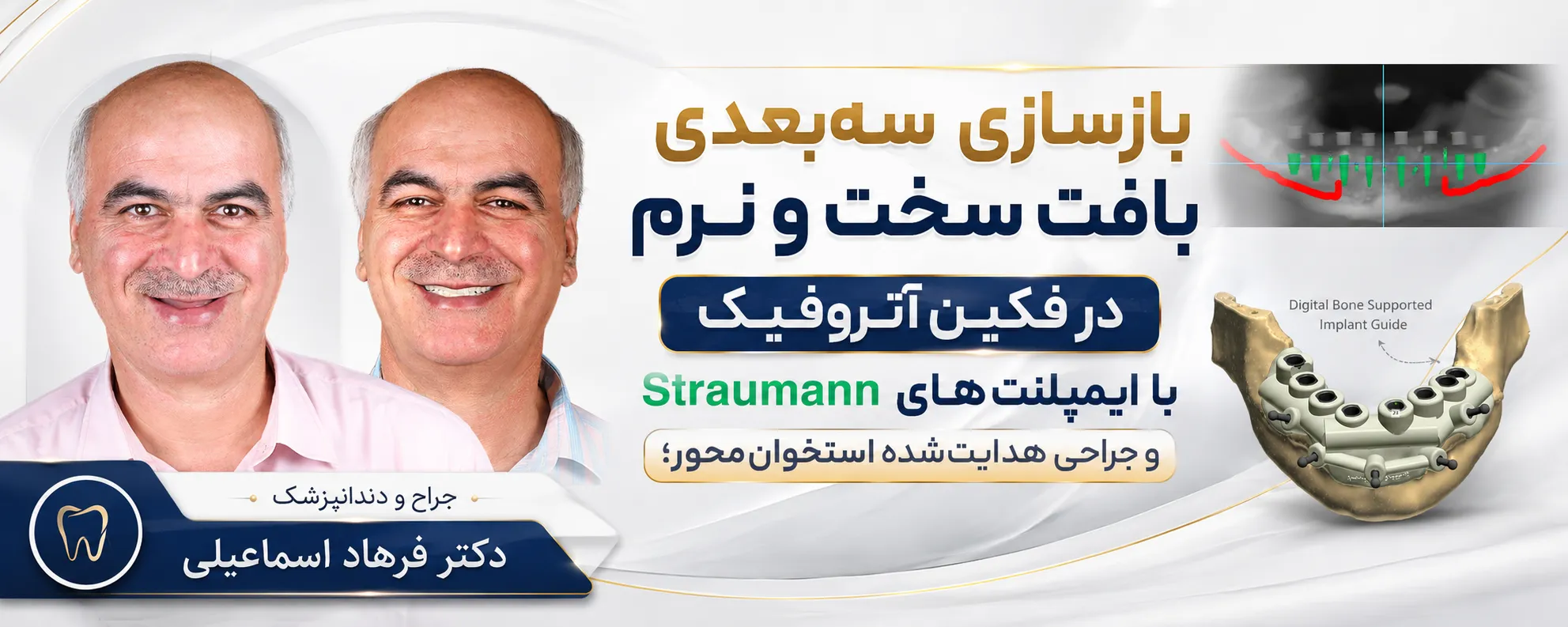 بازسازی فکین آتروفیک با ایمپلنت دیجیتال توسط دکتر فرهاد اسماعیلی
